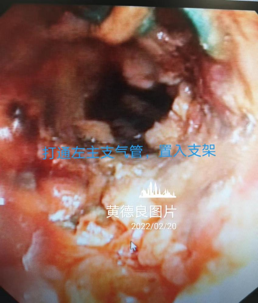 Open the left main bronchus and insert the stent