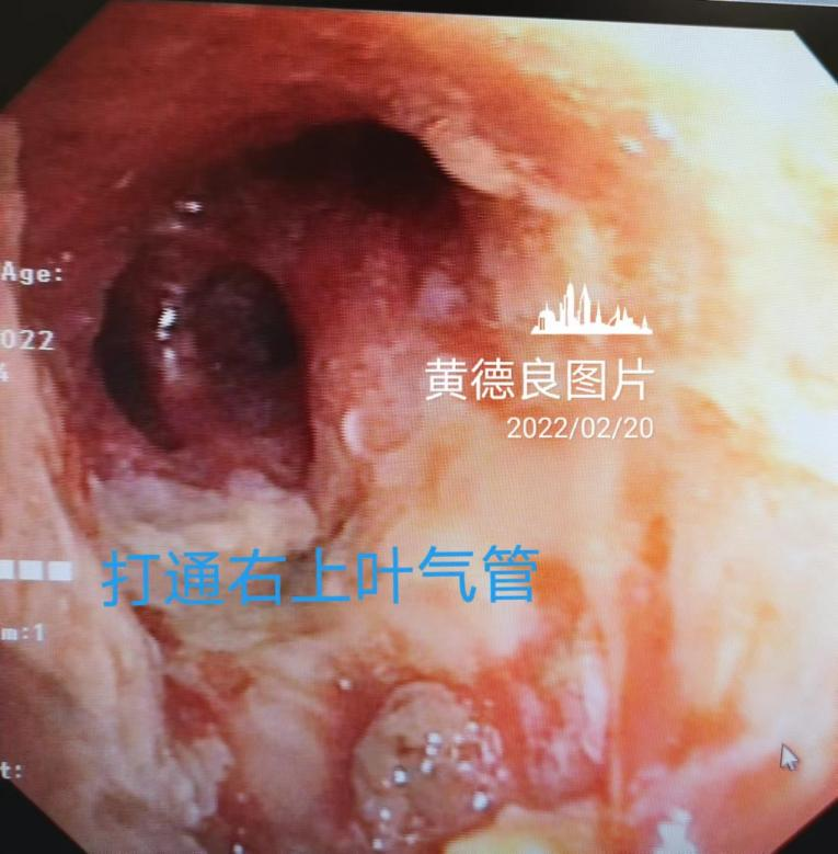 Open the right main bronchus