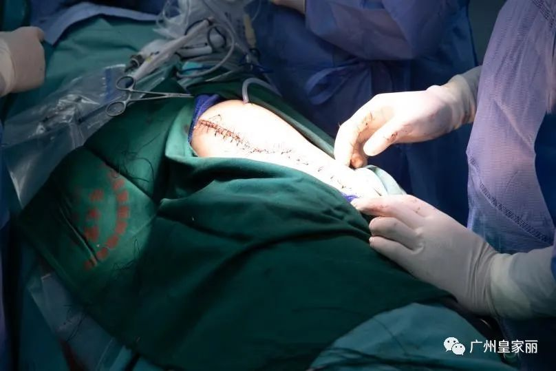 during surgery during surgery